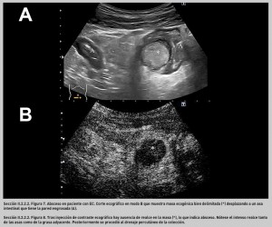 FIGURA 7. Absceso en paciente con EC.