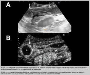 FIGURA 9. Estenosis inflamatoria en paciente con EC.