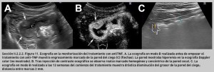 FIGURA 11. Ecografía en la monitorización del tratamiento con antiTNF.