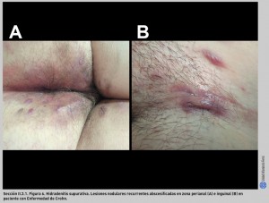FIGURA 6. Hidradenitis supurativa.