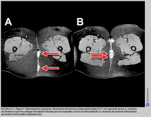 FIGURA 7. Hidrosadenitis supurativa. Resonancia.