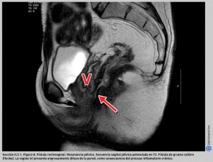 FIGURA 8. Fístula rectovaginal. Resonancia pélvica.