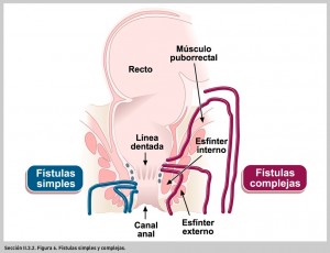 FIGURA 6. Fístulas simples y complejas.