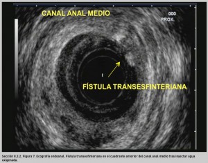 FIGURA 7. Ecografía endoanal. Fístula transesfinteriana.