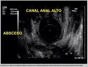 FIGURA 8. Ecografía endoanal. Absceso.