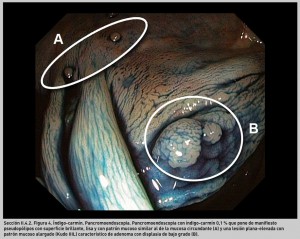 FIGURA 4. Índigo-carmín. Pancromoendoscopia.