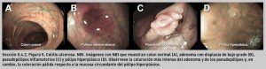 FIGURA 5. Colitis ulcerosa. NBI.