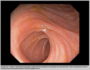 FIGURA 2. Anastomosis quirúrgica.