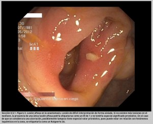 FIGURA 3. Lesión aftosa en la anastomosis.