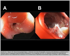 FIGURA 5. EC. A. Recurrencia posquirúrgica. B. Dilatación estenosis EC.