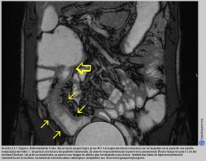 FIGURA 6. Enfermedad de Crohn. Recurrencia posquirúrgica grave iR 3.