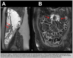 FIGURA 1. Paciente con enfermedad de Crohn con resección ileocecal.