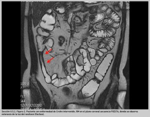 FIGURA 2. Paciente con enfermedad de Crohn intervenido.