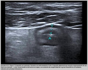 FIGURA 7. Ecografía con contraste. Paciente con enfermedad de Crohn
