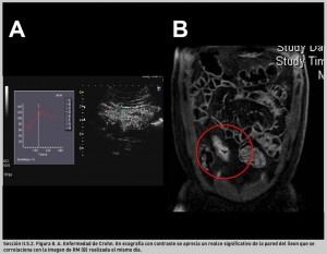 FIGURA 8. Enfermedad de Crohn.