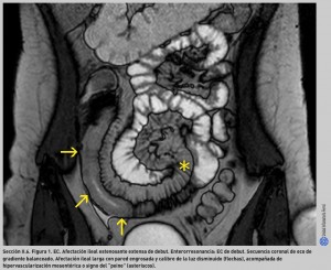 FIGURA 1. EC. Afectación ileal estenosante extensa de debut.