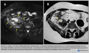 FIGURA 2. EC ileal, fenotipo penetrante. Absceso psoas.