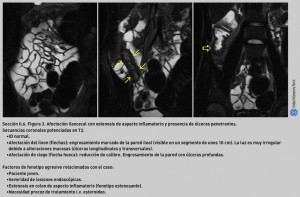 FIGURA 3. Afectación ileocecal con estenosis de aspecto inflamatorio y presencia de úlceras penetrantes.