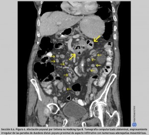 FIGURA 6. Afectación yeyunal por linfoma no Hodking tipo B.