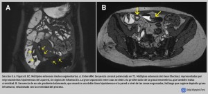 FIGURA 8. EC. Múltiples estenosis ileales segmentarias.
