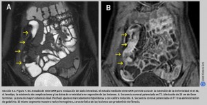FIGURA 9. EC. Estudio de enteroRM para evaluación del daño intestinal.