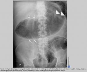 FIGURA 10. Hallazgos en radiografía simplede abdomen en brote de debut grave de CU.