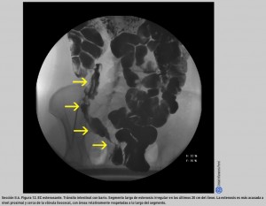 FIGURA 12. EC estenosante. Tránsitointestinal con bario.