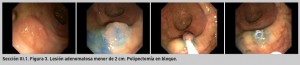 FIGURA 3. Lesión adenomatosa menor de 2 cm. Polipectomía en bloque.