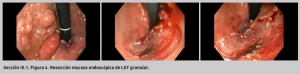 FIGURA 4. Resección mucosa endoscópica de LST granular.