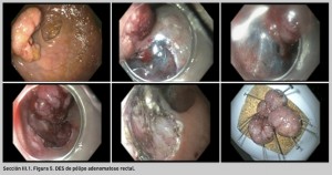 FIGURA 3. DES de pólipo adenomatoso rectal.