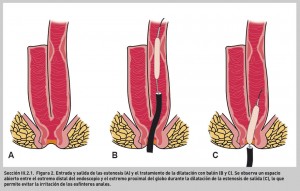FIGURA 2. Entrada y salida de las estenosis (A) y el tratamiento de la dilatación con balón (B y C).