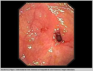 FIGURA 1. Enfermedad de Crohn. Estenosis cólica.