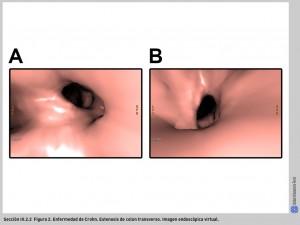 FIGURA 2. Enfermedad de Crohn. Estenosis cólica.