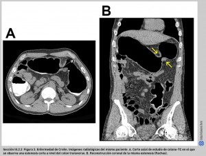 FIGURA 3. Enfermedad de Crohn. Estenosis cólica.
