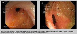 FIGURA 2. A. Imagen endoscópica de una estenosis en colon transverso antes de la inserción de una prótesis. B. Imagen endoscópica del sitio de la estenosis 3 meses después de la extracción de la prótesis21.