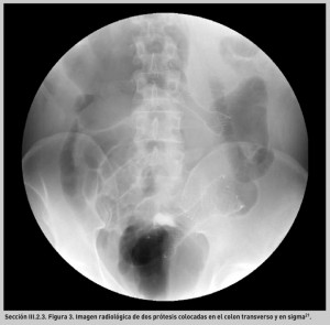 FIGURA 3. Imagen radiológica de dos prótesis colocadas en el colon transverso y en sigma21