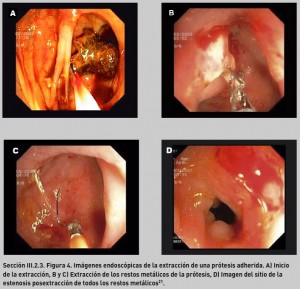FIGURA 3. Imagen radiológica de dos prótesis colocadas en el colon transverso y en sigma21.